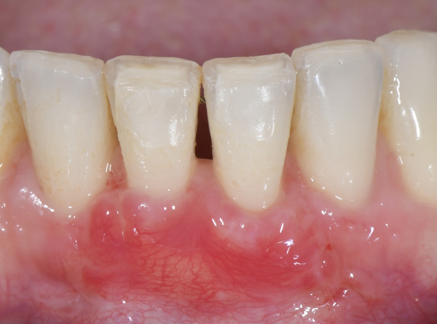 Dopo l'innesto di tessuto connettivo per migliorare protezione e armonia gengivale