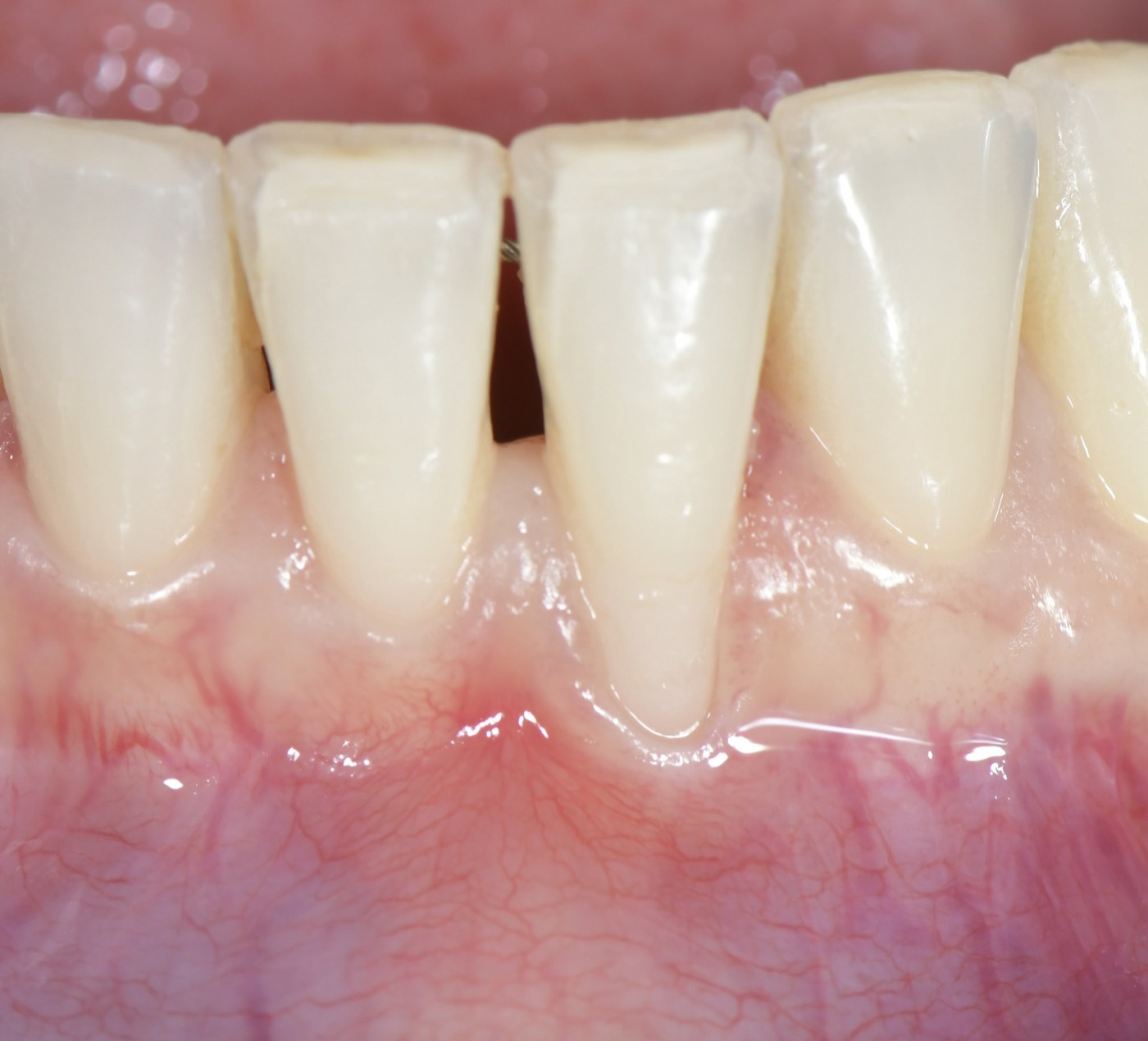 Prima dell'innesto di tessuto connettivo per recessione gengivale