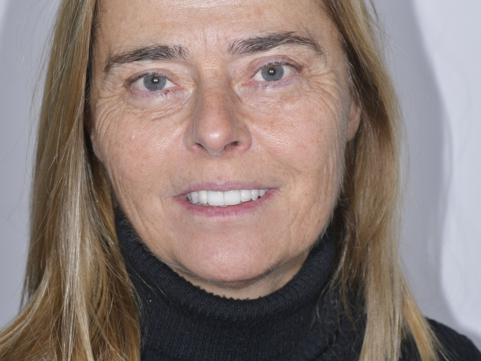 陶瓷贴面美学修复后的结果