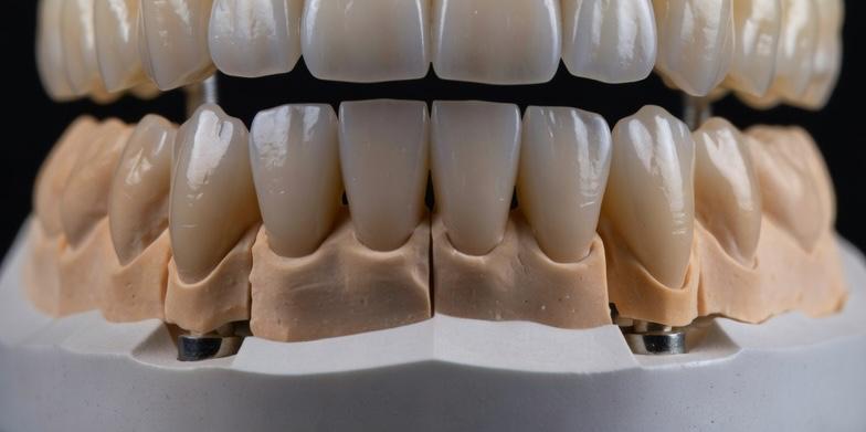 Faccette in Ceramica Feldspatica: L’Arte del Sorriso Naturale