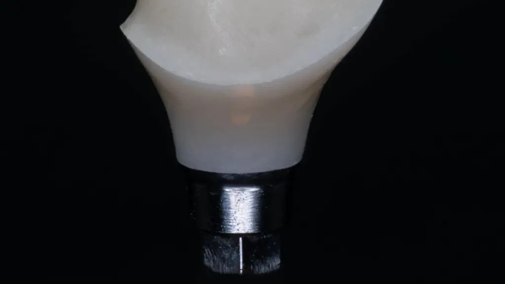Combien de temps dure réellement un implant dentaire ? Horaires, protocoles et technologie à Turin