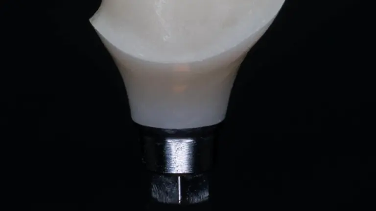 Combien de temps dure réellement un implant dentaire ? Horaires, protocoles et technologie à Turin