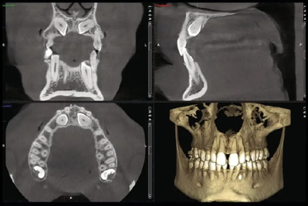 CBCT dal Dentista a Torino: Quando Serve Davvero