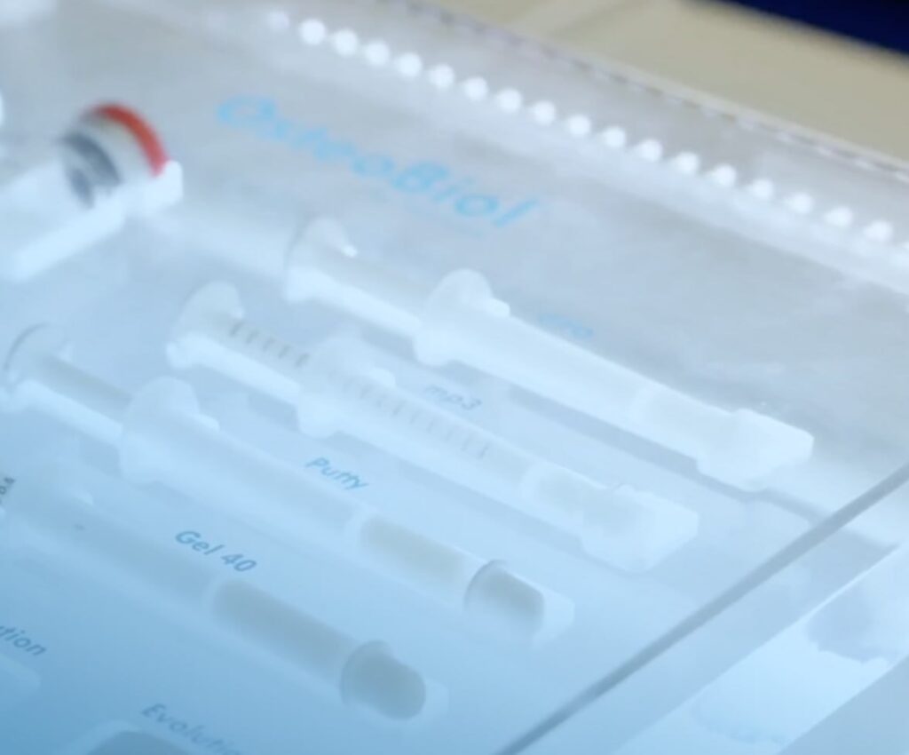 Rialzo di Seno Mascellare a Torino: Guida Completa alla Rigenerazione Ossea