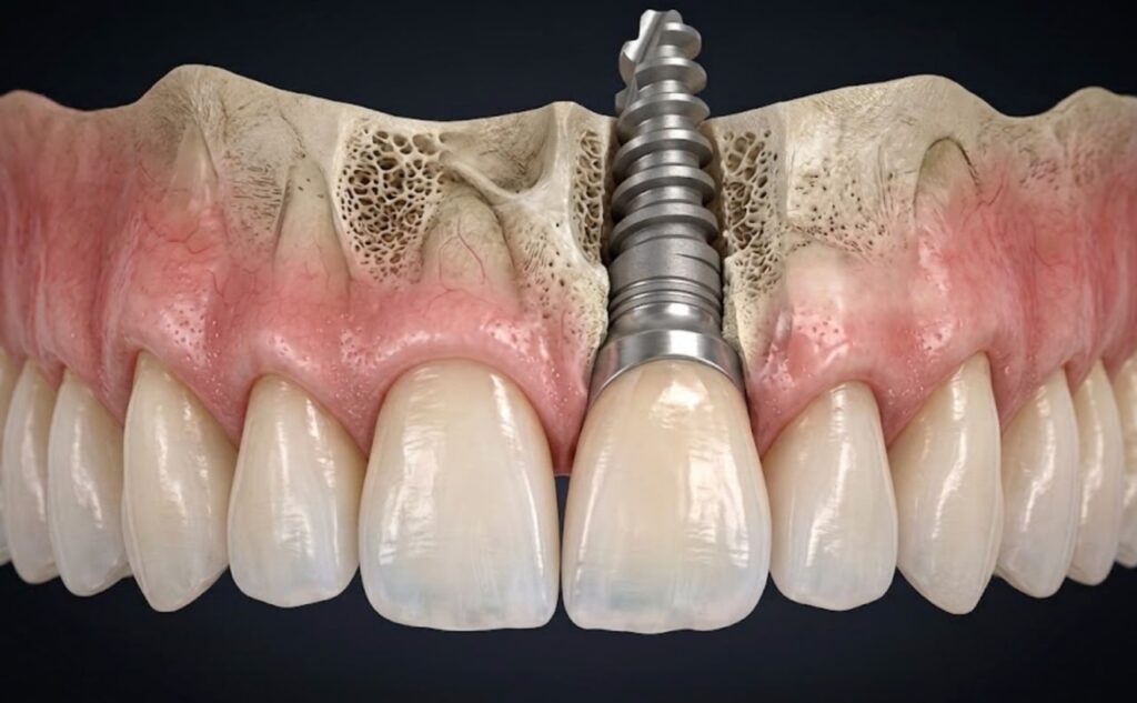 Carico Immediato a Torino: Quando È Indicato