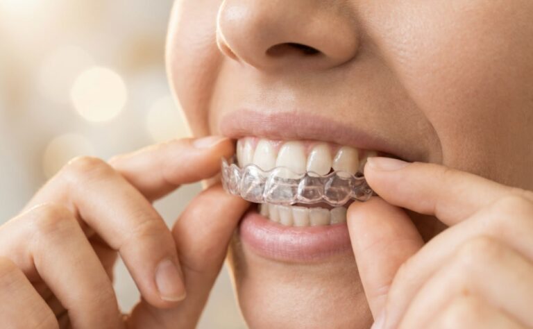 都灵 Invisalign 成人隐适美：时代、限制和优势