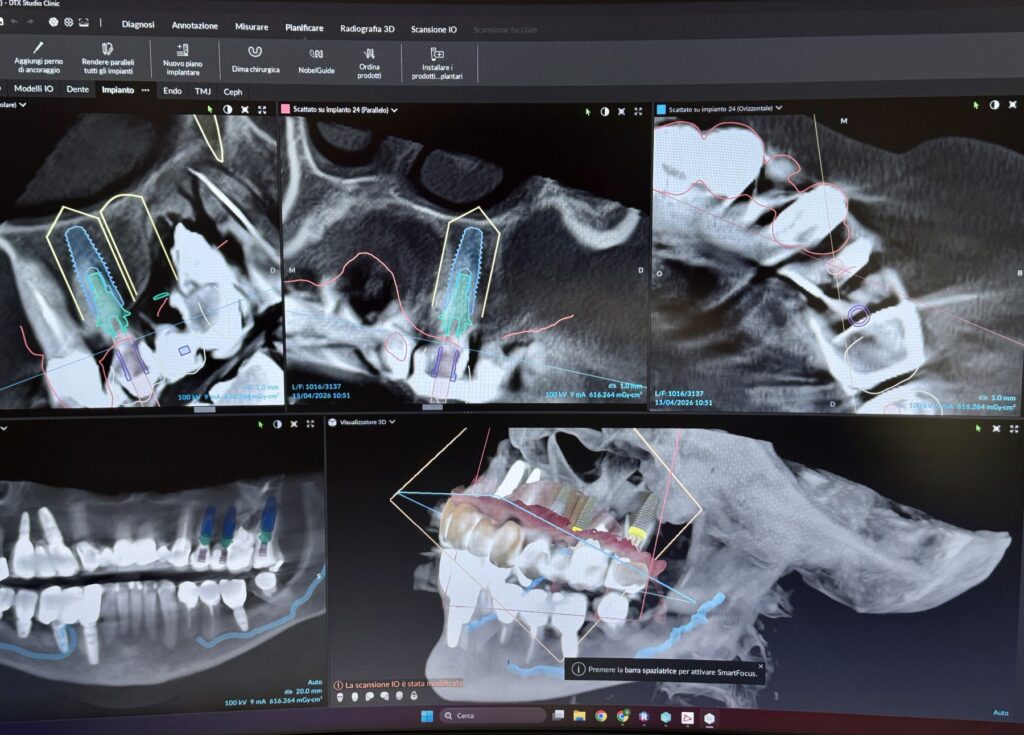 Seconda opinione in implantologia a Torino: quando serve