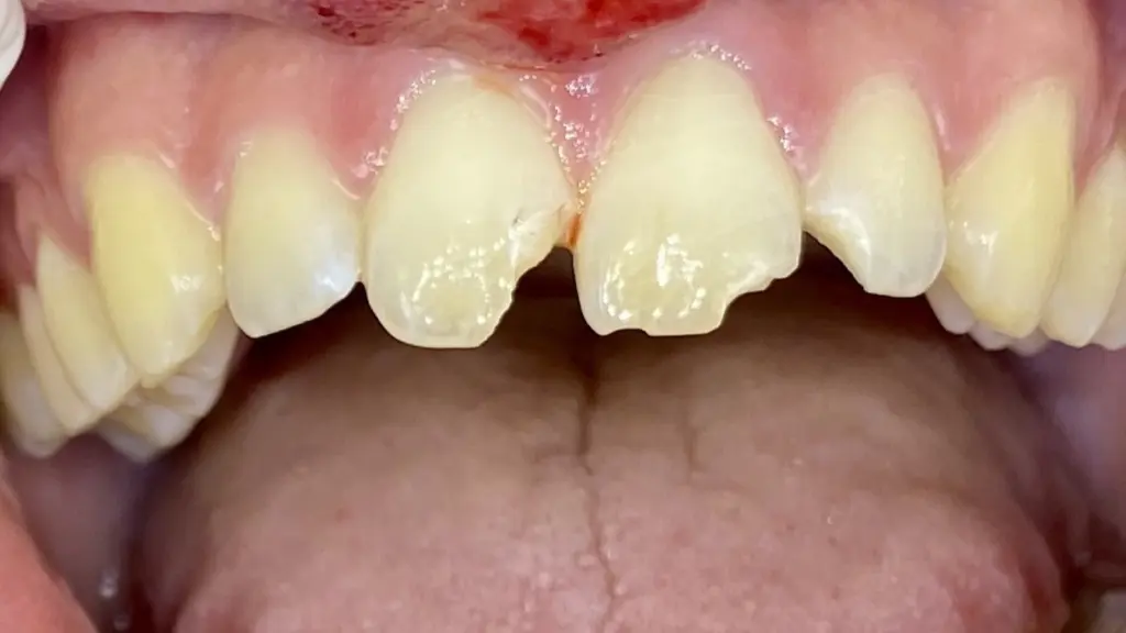 Urgenza dentale a Torino: cosa fare subito in caso di dolore acuto o trauma