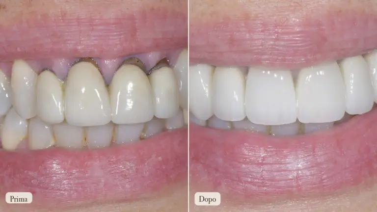 Faccette a Torino: le cinque fasi di un sorriso naturale